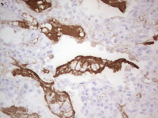 Immunohistochemical staining of paraffin-embedded Carcinoma of Human lung tissue using anti-CSF1 mouse monoclonal antibody