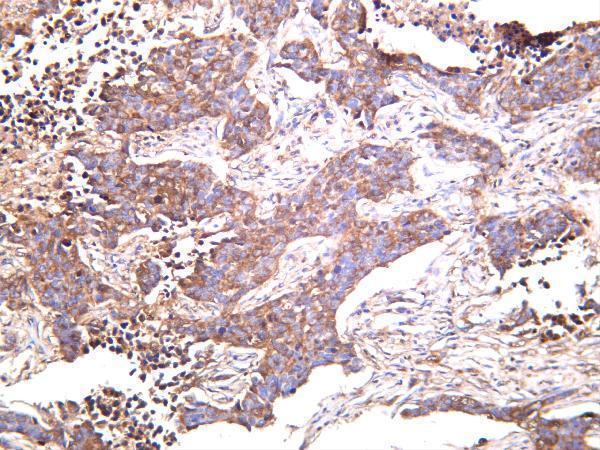 Human lung carcinoma was stained with anti-Sumo 1 rabbit antibody