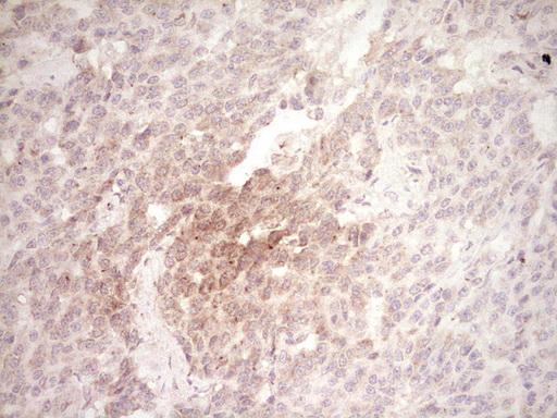 Immunohistochemical staining of paraffin-embedded Carcinoma of Human lung tissue using anti-SPP1 mouse monoclonal antibody