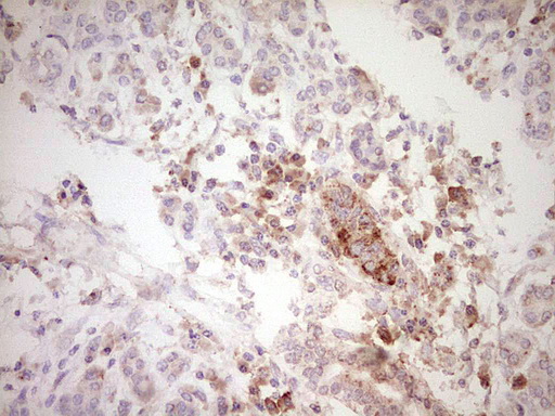 Immunohistochemical staining of paraffin-embedded Carcinoma of Human pancreas tissue using anti-SPP1 mouse monoclonal antibody