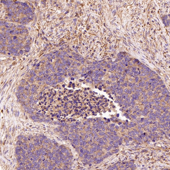 Immunohistochemical analysis of paraffin-embedded Human lung large cell cancer, using the Antibody at 1:50 dilution