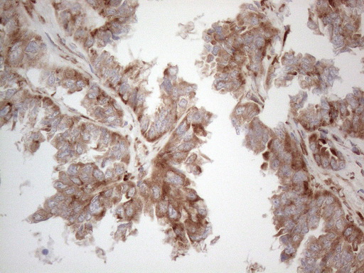Immunohistochemical staining of paraffin-embedded Adenocarcinoma of Human ovary tissue using anti-JAG1 mouse monoclonal antibody