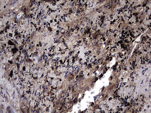 Immunohistochemical staining of paraffin-embedded Carcinoma of Human lung tissue using anti-IL1RN mouse monoclonal antibody