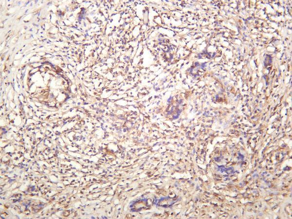 Human thyroid carcinoma was stained with anti-PRKACA rabbit antibody