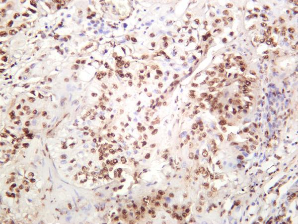 Human bladder carcinoma was stained with anti-DDX5 rabbit antibody