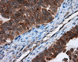 Immunohistochemical staining of paraffin-embedded Adenocarcinoma of ovary tissue using anti-TPMT mouse monoclonal antibody
