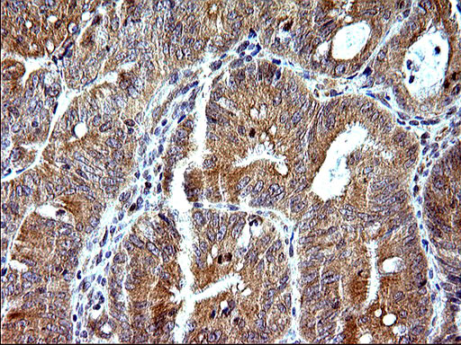 Immunohistochemical staining of paraffin-embedded Carcinoma of Human pancreas tissue using anti-SHBG mouse monoclonal antibody