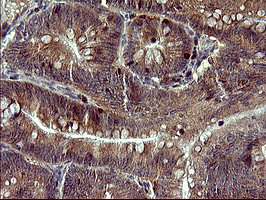 Immunohistochemical staining of paraffin-embedded Carcinoma of Human pancreas tissue using anti-TP73 mouse monoclonal antibody