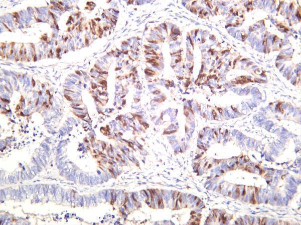 Human colon carcinoma was stained with anti-Cyclin A2 rabbit antibody