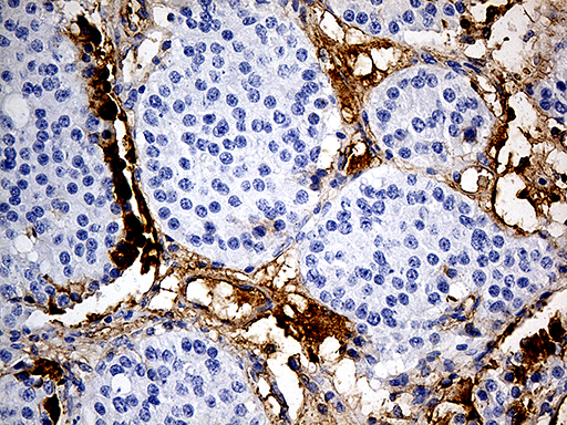 Immunohistochemical staining of paraffin-embedded Carcinoma of Human pancreas tissue using anti-PLG mouse monoclonal antibody