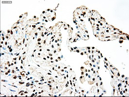 Immunohistochemical staining of paraffin-embedded Carcinoma of Human lung tissue using anti-SSB mouse monoclonal antibody