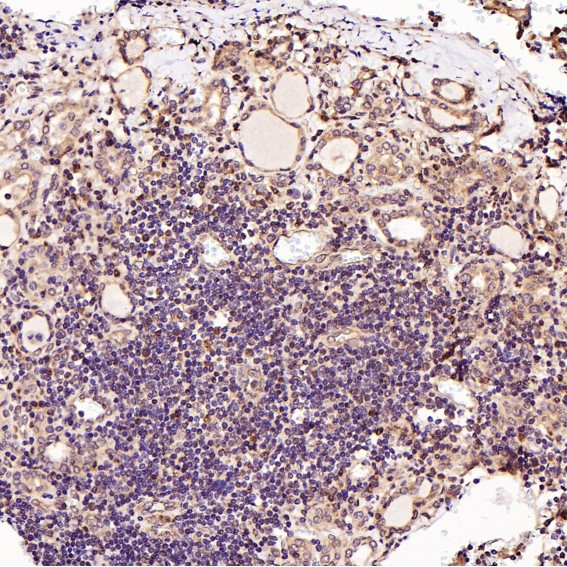 Immunohistochemical analysis of paraffin-embedded Human thyroid cancer, using the Antibody at 1:100 dilution