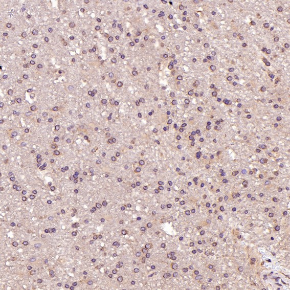Immunohistochemical analysis of paraffin-embedded Human glioblastoma, using the Antibody at 1:100 dilution