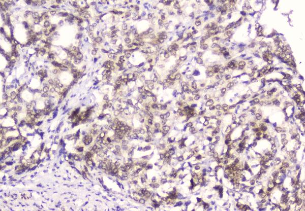 IHC analysis of Emerin using anti-Emerin antibody (M00714). Emerin was detected in paraffin-embedded section of human gastric cancer tissue. Heat mediated antigen retrieval was performed in citrate buffer (pH6, epitope retrieval solution) for 20 mins. The tissue section was blocked with 10% goat serum. The tissue section was then incubated with 2μg/ml mouse anti-Emerin Antibody (M00714) overnight at 4°C. Biotinylated goat anti-mouse IgG was used as secondary antibody and incubated for 30 minutes at 37°C. The tissue section was developed using Strepavidin-Biotin-Complex (SABC)(Catalog # SA1021) with DAB as the chromogen.