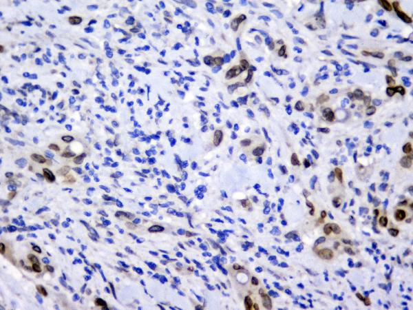 IHC analysis of Emerin using anti-Emerin antibody (M00714). Emerin was detected in paraffin-embedded section of human rectal cancer tissue. Heat mediated antigen retrieval was performed in citrate buffer (pH6, epitope retrieval solution) for 20 mins. The tissue section was blocked with 10% goat serum. The tissue section was then incubated with 2μg/ml mouse anti-Emerin Antibody (M00714) overnight at 4°C. Biotinylated goat anti-mouse IgG was used as secondary antibody and incubated for 30 minutes at 37°C. The tissue section was developed using Strepavidin-Biotin-Complex (SABC)(Catalog # SA1021) with DAB as the chromogen.