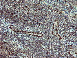 Immunohistochemical staining of paraffin-embedded Human lymphoma tissue using anti-FOXP1 mouse monoclonal antibody at 1:150 (M00723-2)