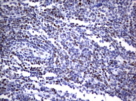 Immunohistochemical staining of paraffin-embedded Human lymphoma tissue using anti-FOXP1 mouse monoclonal antibody