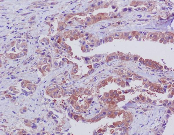 Immunohistochemical analysis of paraffin-embedded human lung, using Bid Antibody