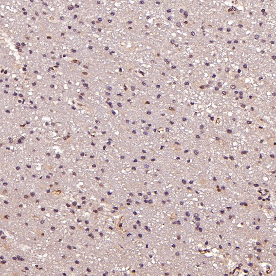 Immunohistochemical analysis of paraffin-embedded Human glioblastoma, using the Antibody at 1:100 dilution