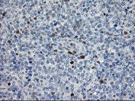 Immunohistochemical staining of paraffin-embedded Human lymphoma tissue using anti-STAT4 mouse monoclonal antibody