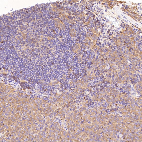 Immunohistochemical analysis of paraffin-embedded Human melanoma, using the Antibody at 1:50 dilution