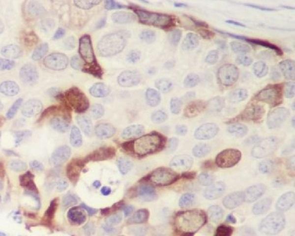 Immunohistochemical analysis of paraffin-embedded human breast cancer, using Cyclin B1 Antibody