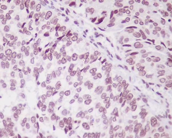 Immunohistochemical analysis of paraffin-embedded human bladder cancer, using PARK7 Antibody