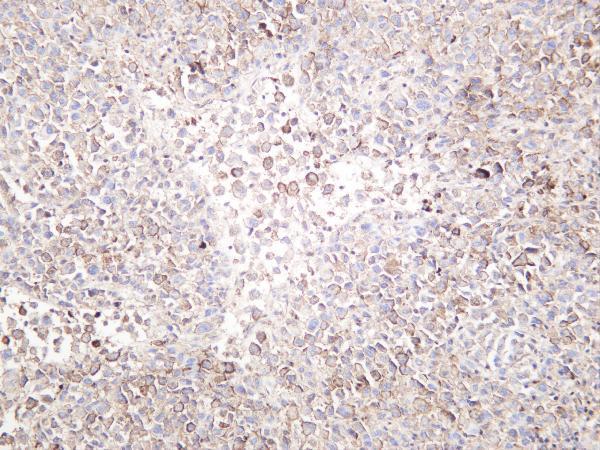 Humanmelanoma was stained with anti-SOX10 rabbit antibody
