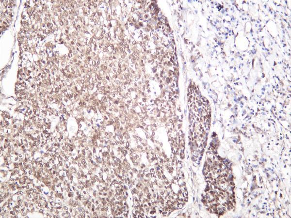 Humanbreastcarcinoma was stained with anti-SOX10 rabbit antibody