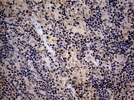 Immunohistochemical staining of paraffin-embedded Carcinoma of Human lung tissue using anti-ITGB1 mouse monoclonal antibody