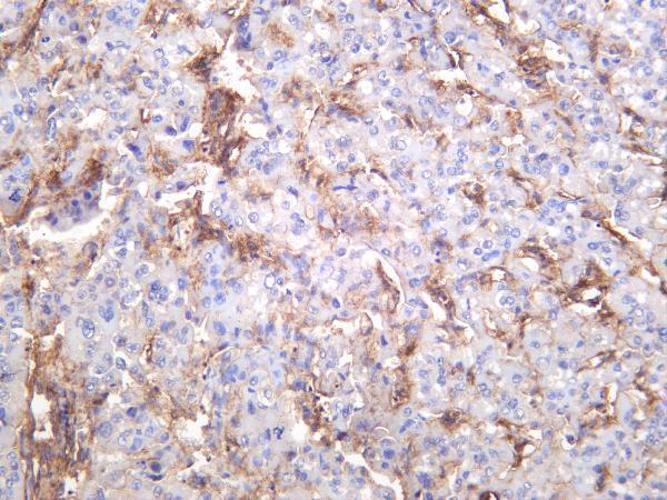 Human hepatocellular carcinoma was stained with anti-Integrin β1 rabbit antibody