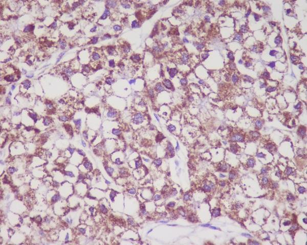 Immunohistochemical analysis of paraffin-embedded human liver cancer, using MMP3 Antibody