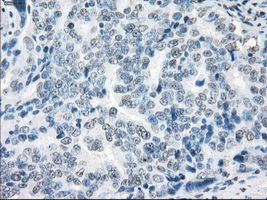 Immunohistochemical staining of paraffin-embedded Adenocarcinoma of ovary tissue using anti-XRCC4mouse monoclonal antibody
