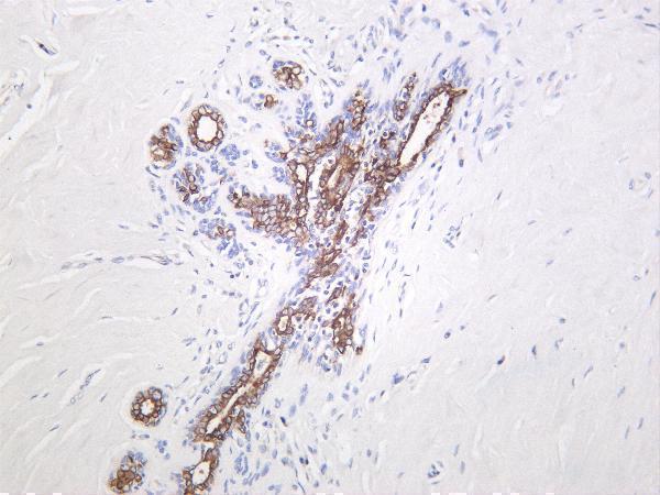 Human breast carcinoma was stained with Anti-GSK3 β (phospho Ser9) rabbit antibody