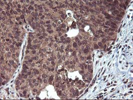 Immunohistochemical staining of paraffin-embedded Carcinoma of Human lung tissue using anti-FGF21 mouse monoclonal antibody