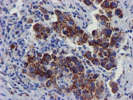 Immunohistochemical staining of paraffin-embedded Carcinoma of Human lung tissue using anti-FXN mouse monoclonal antibody