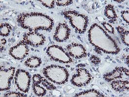 Immunohistochemical staining of paraffin-embedded Carcinoma of Human thyroid tissue using anti-FXN mouse monoclonal antibody