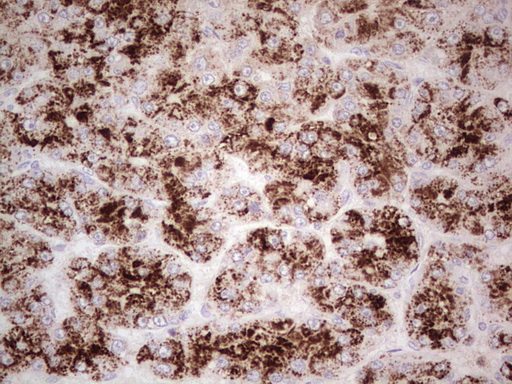 Immunohistochemical staining of paraffin-embedded Carcinoma of Human liver tissue using anti-ANGPT1 mouse monoclonal antibody