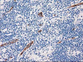 Immunohistochemical staining of paraffin-embedded Human lymphoma tissue using anti-AQP1 mouse monoclonal antibody