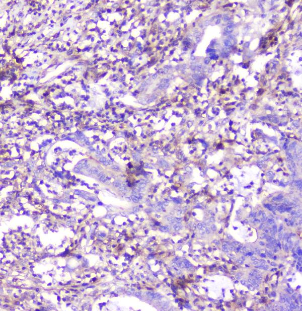 IHC analysis of ADA using anti-ADA antibody (M00866). ADA was detected in paraffin-embedded section of human colon cancer tissue. Heat mediated antigen retrieval was performed in citrate buffer (pH6, epitope retrieval solution) for 20 mins. The tissue section was blocked with 10% goat serum. The tissue section was then incubated with 1μg/ml mouse anti-ADA Antibody (M00866) overnight at 4°C. Biotinylated goat anti-mouse IgG was used as secondary antibody and incubated for 30 minutes at 37°C. The tissue section was developed using Strepavidin-Biotin-Complex (SABC)(Catalog # SA1021) with DAB as the chromogen.
