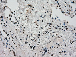 Immunohistochemical staining of paraffin-embedded Carcinoma of Human lung tissue using anti-GCK mouse monoclonal antibody