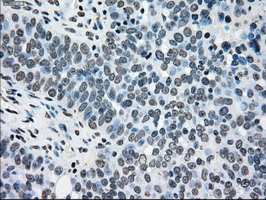 Immunohistochemical staining of paraffin-embedded Adenocarcinoma of Human ovary tissue using anti-TYRO3 mouse monoclonal antibody