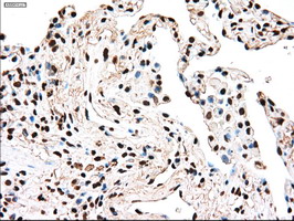 Immunohistochemical staining of paraffin-embedded Carcinoma of Human lung tissue using anti-TYRO3 mouse monoclonal antibody