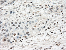Immunohistochemical staining of paraffin-embedded Carcinoma of Human pancreas tissue using anti-TYRO3 mouse monoclonal antibody