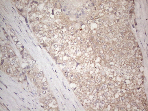 Immunohistochemical staining of paraffin-embedded Adenocarcinoma of Human endometrium tissue using anti-IGFBP1 mouse monoclonal antibody