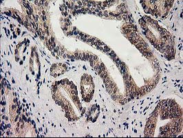 Immunohistochemical staining of paraffin-embedded Carcinoma of Human prostate tissue using anti-GSS mouse monoclonal antibody