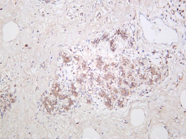 Human breast carcinoma was stained with anti-ASK1 rabbit antibody