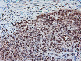 Immunohistochemical staining of paraffin-embedded Adenocarcinoma of Human ovary tissue using anti-CYP2A6 mouse monoclonal antibody