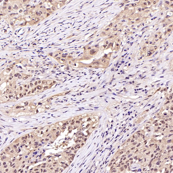 Immunohistochemical analysis of paraffin-embedded Human squamous carcinoma, using the Antibody at 1:200 dilution