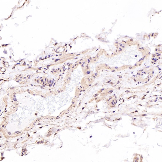 Immunohistochemical analysis of paraffin-embedded Human testis cancer, using the Antibody at 1:200 dilution